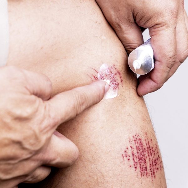 Person applying white antiseptic cream onto painful wound from abrasive fall